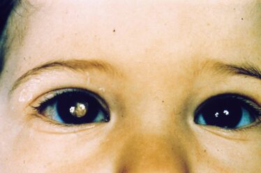 Pupila branca e reflexo de olho de gato | Entenda condição que