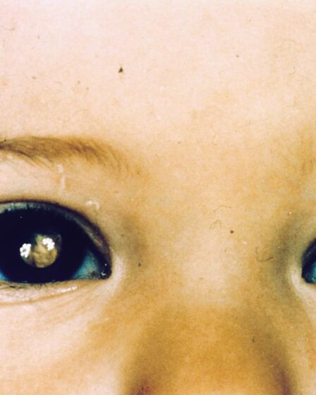 Pupila branca e reflexo de olho de gato | Entenda condição que